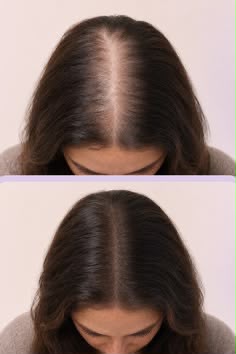 Before en after haargroei-mesotherapie, kruin