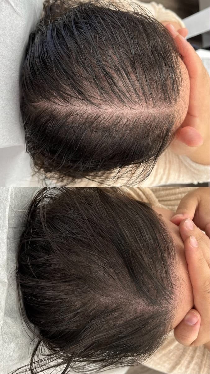 Before en after haargroei-mesotherapie, scheiding