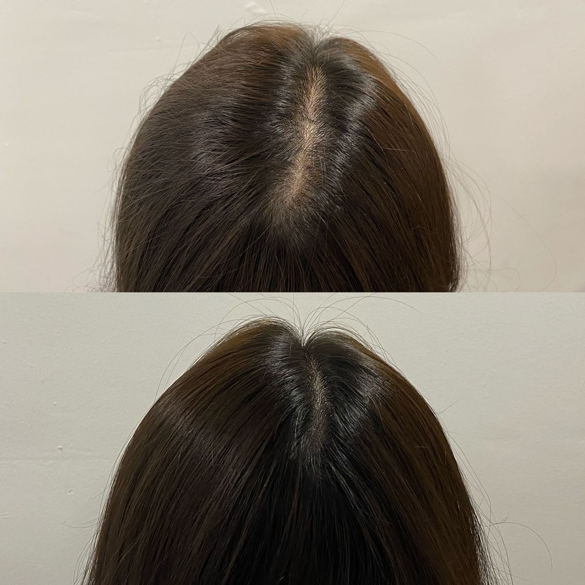 Before en after haargroei-mesotherapie, haarlijn